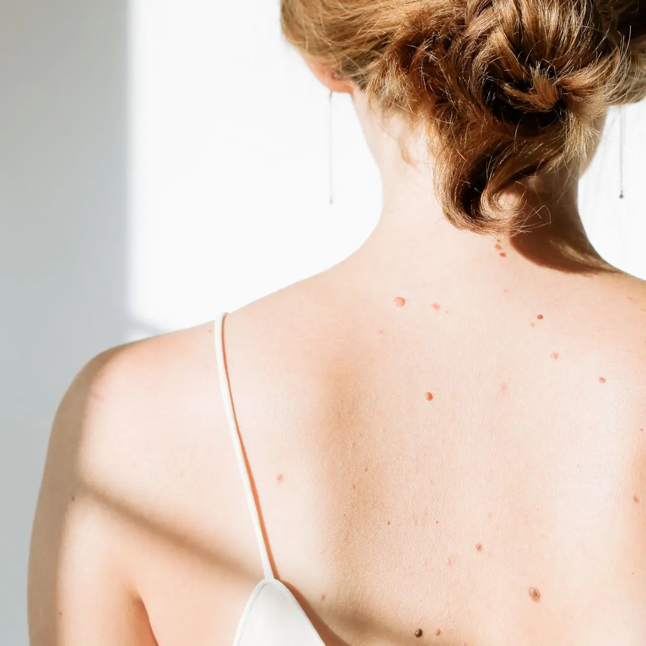 Exérèse de grains de beauté kystes tumeurs cutanées