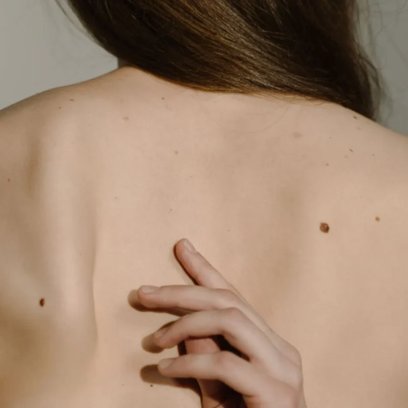 grain de beauté suspect : carcinome mélanome