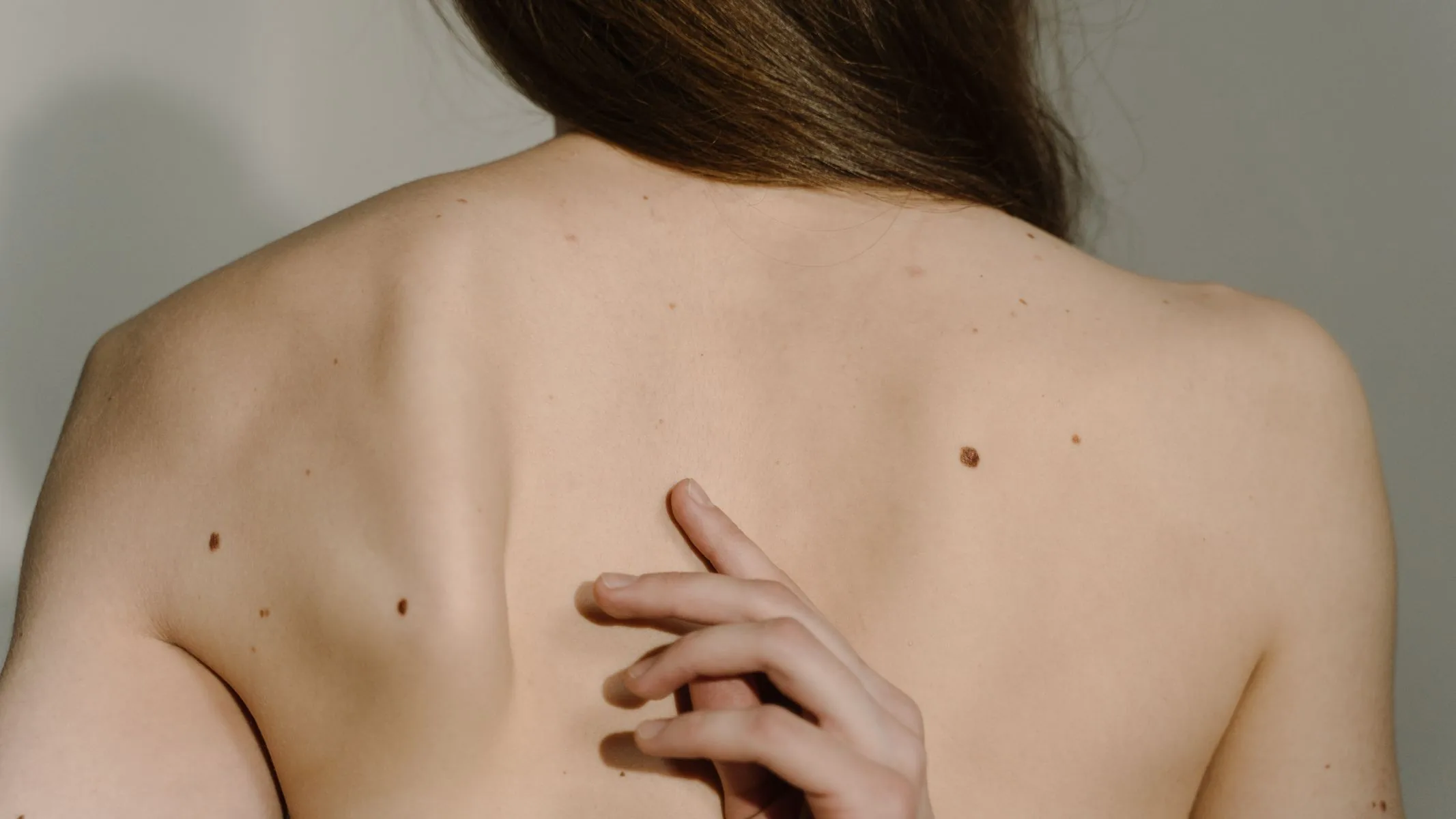 grain de beauté suspect : carcinome mélanome